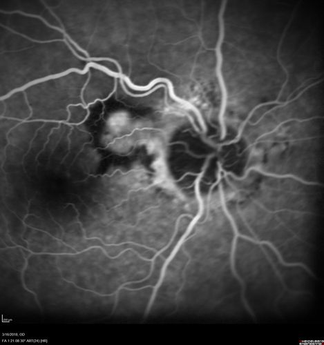 Juxtapapillary CNVM - Hemorrhage
83 year old female VA 20/200 improved to 20/32 within 2 months with Lucentis
