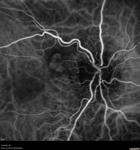 Juxtapapillary CNVM - Hemorrhage
83 year old female VA 20/200 improved to 20/32 within 2 months with Lucentis
