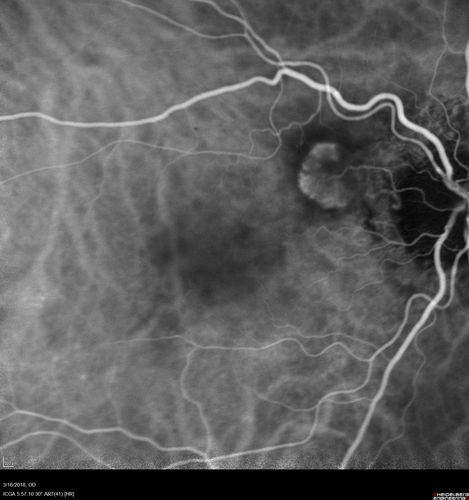 Juxtapapillary CNVM - Hemorrhage
83 year old female VA 20/200 improved to 20/32 within 2 months with Lucentis
