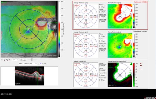 Juxtapapillary CNVM - Hemorrhage
83 year old female VA 20/200 improved to 20/32 within 2 months with Lucentis
