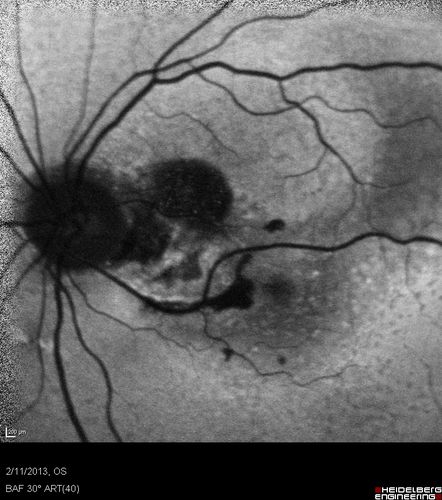 Asymptomatic Juxtapapillary Choroidal Neovascular Membrane - Reticular Macular Disease (Wet AMD) - FAF
