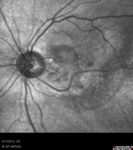 Asymptomatic Juxtapapillary Choroidal Neovascular Membrane - Reticular Macular Disease (Wet AMD) 
