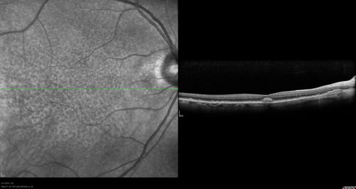 Asymptomatic Juxtapapillary Choroidal Neovascular Membrane - Reticular Macular Disease (Wet AMD) 
