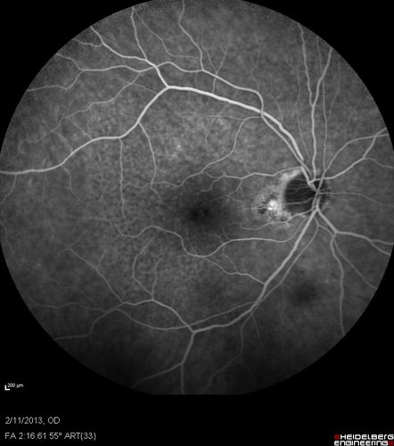 Asymptomatic Juxtapapillary Choroidal Neovascular Membrane - Reticular Macular Disease (Wet AMD) 
