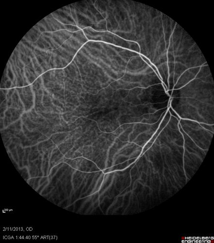 Asymptomatic Juxtapapillary Choroidal Neovascular Membrane - Reticular Macular Disease (Wet AMD) 
