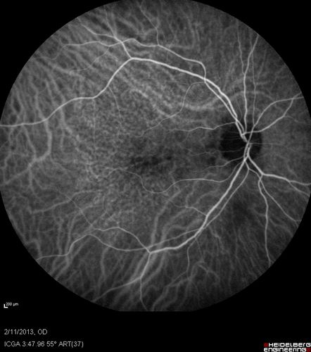 Asymptomatic Juxtapapillary Choroidal Neovascular Membrane - Reticular Macular Disease (Wet AMD) 
