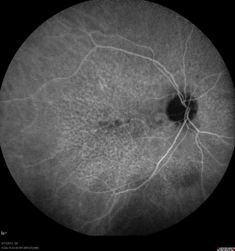 Asymptomatic Juxtapapillary Choroidal Neovascular Membrane - Reticular Macular Disease (Wet AMD) 
