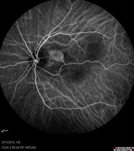 Asymptomatic Juxtapapillary Choroidal Neovascular Membrane - Reticular Macular Disease (Wet AMD) 

