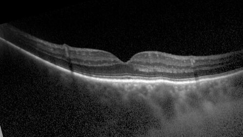 Lamellar Macular Hole - Evoluation over 5 years
65 year old man with Sturge weber and a choroidal hemangioma in the left eye.  (See other images under sturge weber on this website). Has ongoing problem with his left eye.  Now with Blurred vision in the right eye gradually worse the last few weeks.  He has had a vitrectomy in the right eye 4 years ago for floaters.  Laser for tears and cryo in the right eye 5 years ago. He is on Dorzolamide and Lumigan for glaucoma.
VA 20/32 OD, 20/40 OS
IOP 23 OD, 19 OS
