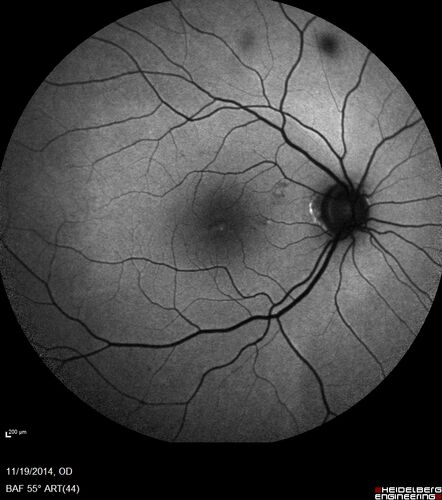 Lamellar Macular Hole - Evoluation over 5 years
65 year old man with Sturge weber and a choroidal hemangioma in the left eye.  (See other images under sturge weber on this website). Has ongoing problem with his left eye.  Now with Blurred vision in the right eye gradually worse the last few weeks.  He has had a vitrectomy in the right eye 4 years ago for floaters.  Laser for tears and cryo in the right eye 5 years ago. He is on Dorzolamide and Lumigan for glaucoma.
VA 20/32 OD, 20/40 OS
IOP 23 OD, 19 OS
