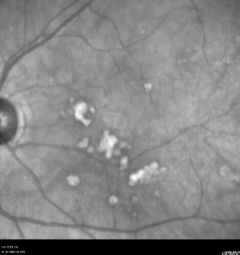 Large Hyper-reflective drusen in age-related macular degeneration
69 year old healthy woman with 20/20 vision and no visual complaints
