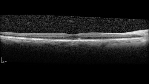 Large Hyper-reflective drusen in age-related macular degeneration
69 year old healthy woman with 20/20 vision and no visual complaints
