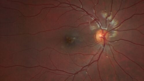Laser pointer maculopathy
11 year old male When school started the patient noticed that he was having trouble reading and seeing out of both eyes. There are no retinal diseases in the family.
VA OD: sc20/25
VA OS: sc20/40 
TP: OD:19 OS:18 

The FOBSERD ZK-9318 laser pointer is a long range green beam high power flashlight. It has an average power of 60-90 mw. 
You can buy the ZK-9318 laser pointer on Amazon

I also found this:
The FOBSERD ZK-9318 laser pointer is a class III laser with a 532nm wavelength and can be seen up to 1 mile away. It has a maximum power output of 5mW and creates a low-power visible laser beam.

One review on amazon says this:
 Powerful
By Savvy Logic in the United States on March 17, 2023
I measured the wattage at about 150 MW on an optical Power Meter
