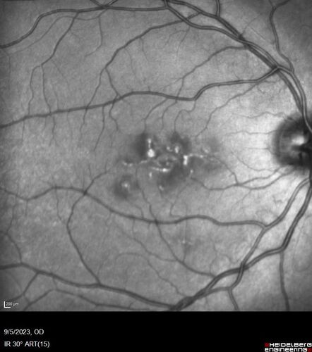 Laser pointer maculopathy
11 year old male When school started the patient noticed that he was having trouble reading and seeing out of both eyes. There are no retinal diseases in the family.
VA OD: sc20/25
VA OS: sc20/40 
TP: OD:19 OS:18 

The FOBSERD ZK-9318 laser pointer is a long range green beam high power flashlight. It has an average power of 60-90 mw. 
You can buy the ZK-9318 laser pointer on Amazon

I also found this:
The FOBSERD ZK-9318 laser pointer is a class III laser with a 532nm wavelength and can be seen up to 1 mile away. It has a maximum power output of 5mW and creates a low-power visible laser beam.

One review on amazon says this:
 Powerful
By Savvy Logic in the United States on March 17, 2023
I measured the wattage at about 150 MW on an optical Power Meter
