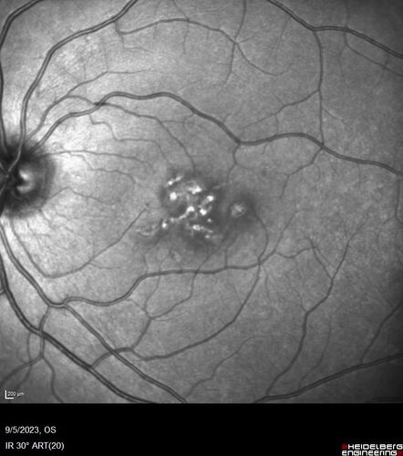 Laser pointer maculopathy
11 year old male When school started the patient noticed that he was having trouble reading and seeing out of both eyes. There are no retinal diseases in the family.
VA OD: sc20/25
VA OS: sc20/40 
TP: OD:19 OS:18 

The FOBSERD ZK-9318 laser pointer is a long range green beam high power flashlight. It has an average power of 60-90 mw. 
You can buy the ZK-9318 laser pointer on Amazon

I also found this:
The FOBSERD ZK-9318 laser pointer is a class III laser with a 532nm wavelength and can be seen up to 1 mile away. It has a maximum power output of 5mW and creates a low-power visible laser beam.

One review on amazon says this:
 Powerful
By Savvy Logic in the United States on March 17, 2023
I measured the wattage at about 150 MW on an optical Power Meter
