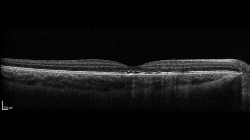 Laser pointer maculopathy
11 year old male When school started the patient noticed that he was having trouble reading and seeing out of both eyes. There are no retinal diseases in the family.
VA OD: sc20/25
VA OS: sc20/40 
TP: OD:19 OS:18 

The FOBSERD ZK-9318 laser pointer is a long range green beam high power flashlight. It has an average power of 60-90 mw. 
You can buy the ZK-9318 laser pointer on Amazon

I also found this:
The FOBSERD ZK-9318 laser pointer is a class III laser with a 532nm wavelength and can be seen up to 1 mile away. It has a maximum power output of 5mW and creates a low-power visible laser beam.

One review on amazon says this:
 Powerful
By Savvy Logic in the United States on March 17, 2023
I measured the wattage at about 150 MW on an optical Power Meter
