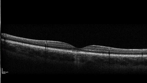 Laser pointer maculopathy
11 year old male When school started the patient noticed that he was having trouble reading and seeing out of both eyes. There are no retinal diseases in the family.
VA OD: sc20/25
VA OS: sc20/40 
TP: OD:19 OS:18 

The FOBSERD ZK-9318 laser pointer is a long range green beam high power flashlight. It has an average power of 60-90 mw. 
You can buy the ZK-9318 laser pointer on Amazon

I also found this:
The FOBSERD ZK-9318 laser pointer is a class III laser with a 532nm wavelength and can be seen up to 1 mile away. It has a maximum power output of 5mW and creates a low-power visible laser beam.

One review on amazon says this:
 Powerful
By Savvy Logic in the United States on March 17, 2023
I measured the wattage at about 150 MW on an optical Power Meter
