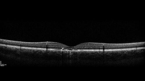 Laser pointer maculopathy
11 year old male When school started the patient noticed that he was having trouble reading and seeing out of both eyes. There are no retinal diseases in the family.
VA OD: sc20/25
VA OS: sc20/40 
TP: OD:19 OS:18 

The FOBSERD ZK-9318 laser pointer is a long range green beam high power flashlight. It has an average power of 60-90 mw. 
You can buy the ZK-9318 laser pointer on Amazon

I also found this:
The FOBSERD ZK-9318 laser pointer is a class III laser with a 532nm wavelength and can be seen up to 1 mile away. It has a maximum power output of 5mW and creates a low-power visible laser beam.

One review on amazon says this:
 Powerful
By Savvy Logic in the United States on March 17, 2023
I measured the wattage at about 150 MW on an optical Power Meter

