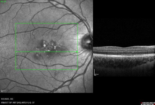 Laser pointer maculopathy
11 year old male When school started the patient noticed that he was having trouble reading and seeing out of both eyes. There are no retinal diseases in the family.
VA OD: sc20/25
VA OS: sc20/40 
TP: OD:19 OS:18 

The FOBSERD ZK-9318 laser pointer is a long range green beam high power flashlight. It has an average power of 60-90 mw. 
You can buy the ZK-9318 laser pointer on Amazon

I also found this:
The FOBSERD ZK-9318 laser pointer is a class III laser with a 532nm wavelength and can be seen up to 1 mile away. It has a maximum power output of 5mW and creates a low-power visible laser beam.

One review on amazon says this:
 Powerful
By Savvy Logic in the United States on March 17, 2023
I measured the wattage at about 150 MW on an optical Power Meter
