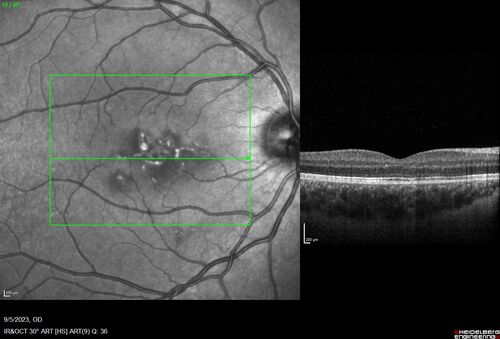 Laser pointer maculopathy
11 year old male When school started the patient noticed that he was having trouble reading and seeing out of both eyes. There are no retinal diseases in the family.
VA OD: sc20/25
VA OS: sc20/40 
TP: OD:19 OS:18 

The FOBSERD ZK-9318 laser pointer is a long range green beam high power flashlight. It has an average power of 60-90 mw. 
You can buy the ZK-9318 laser pointer on Amazon

I also found this:
The FOBSERD ZK-9318 laser pointer is a class III laser with a 532nm wavelength and can be seen up to 1 mile away. It has a maximum power output of 5mW and creates a low-power visible laser beam.

One review on amazon says this:
 Powerful
By Savvy Logic in the United States on March 17, 2023
I measured the wattage at about 150 MW on an optical Power Meter
