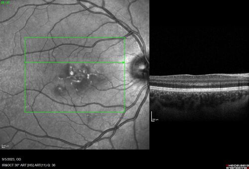 Laser pointer maculopathy
11 year old male When school started the patient noticed that he was having trouble reading and seeing out of both eyes. There are no retinal diseases in the family.
VA OD: sc20/25
VA OS: sc20/40 
TP: OD:19 OS:18 

The FOBSERD ZK-9318 laser pointer is a long range green beam high power flashlight. It has an average power of 60-90 mw. 
You can buy the ZK-9318 laser pointer on Amazon

I also found this:
The FOBSERD ZK-9318 laser pointer is a class III laser with a 532nm wavelength and can be seen up to 1 mile away. It has a maximum power output of 5mW and creates a low-power visible laser beam.

One review on amazon says this:
 Powerful
By Savvy Logic in the United States on March 17, 2023
I measured the wattage at about 150 MW on an optical Power Meter

