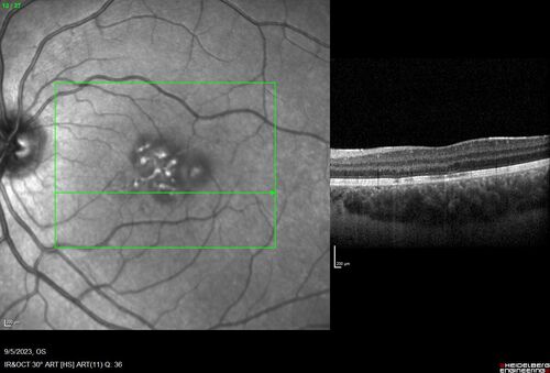 Laser pointer maculopathy
11 year old male When school started the patient noticed that he was having trouble reading and seeing out of both eyes. There are no retinal diseases in the family.
VA OD: sc20/25
VA OS: sc20/40 
TP: OD:19 OS:18 

The FOBSERD ZK-9318 laser pointer is a long range green beam high power flashlight. It has an average power of 60-90 mw. 
You can buy the ZK-9318 laser pointer on Amazon

I also found this:
The FOBSERD ZK-9318 laser pointer is a class III laser with a 532nm wavelength and can be seen up to 1 mile away. It has a maximum power output of 5mW and creates a low-power visible laser beam.

One review on amazon says this:
 Powerful
By Savvy Logic in the United States on March 17, 2023
I measured the wattage at about 150 MW on an optical Power Meter
