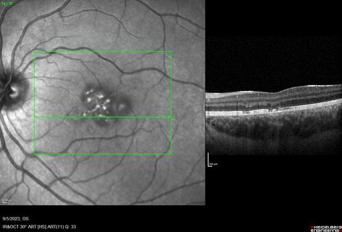 Laser pointer maculopathy
11 year old male When school started the patient noticed that he was having trouble reading and seeing out of both eyes. There are no retinal diseases in the family.
VA OD: sc20/25
VA OS: sc20/40 
TP: OD:19 OS:18 

The FOBSERD ZK-9318 laser pointer is a long range green beam high power flashlight. It has an average power of 60-90 mw. 
You can buy the ZK-9318 laser pointer on Amazon

I also found this:
The FOBSERD ZK-9318 laser pointer is a class III laser with a 532nm wavelength and can be seen up to 1 mile away. It has a maximum power output of 5mW and creates a low-power visible laser beam.

One review on amazon says this:
 Powerful
By Savvy Logic in the United States on March 17, 2023
I measured the wattage at about 150 MW on an optical Power Meter
