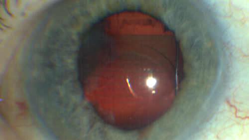 lensfragments_dislocated_IOL_elros_03022005.png