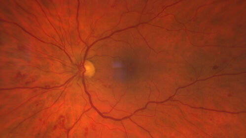 Chronic Myelogenous Leukemia and Diabetic Macular Edema
71 year old female with 3 months of vision loss and not feeling well.  She has been bruising on her legs.  Her vision was 20/100 in each eye with macular edema.  She was treated with Avastin and her CBC was checked.  She had a WBC of 267 thousand and was diagnosed with CML.
