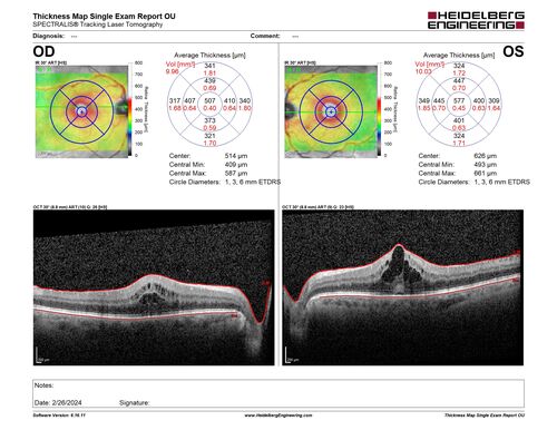 Chronic Myelogenous Leukemia and Diabetic Macular Edema
71 year old female with 3 months of vision loss and not feeling well.  She has been bruising on her legs.  Her vision was 20/100 in each eye with macular edema.  She was treated with Avastin and her CBC was checked.  She had a WBC of 267 thousand and was diagnosed with CML.
