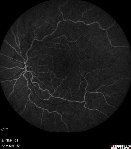 Chronic Myelogenous Leukemia and Diabetic Macular Edema
71 year old female with 3 months of vision loss and not feeling well.  She has been bruising on her legs.  Her vision was 20/100 in each eye with macular edema.  She was treated with Avastin and her CBC was checked.  She had a WBC of 267 thousand and was diagnosed with CML.
