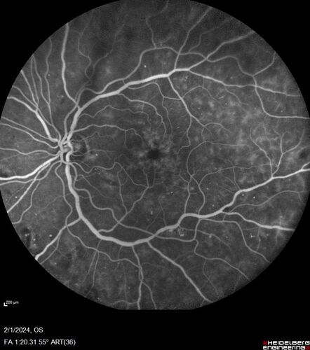 Chronic Myelogenous Leukemia and Diabetic Macular Edema
71 year old female with 3 months of vision loss and not feeling well.  She has been bruising on her legs.  Her vision was 20/100 in each eye with macular edema.  She was treated with Avastin and her CBC was checked.  She had a WBC of 267 thousand and was diagnosed with CML.
