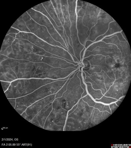 Chronic Myelogenous Leukemia and Diabetic Macular Edema
71 year old female with 3 months of vision loss and not feeling well.  She has been bruising on her legs.  Her vision was 20/100 in each eye with macular edema.  She was treated with Avastin and her CBC was checked.  She had a WBC of 267 thousand and was diagnosed with CML.
