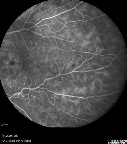 Chronic Myelogenous Leukemia and Diabetic Macular Edema
71 year old female with 3 months of vision loss and not feeling well.  She has been bruising on her legs.  Her vision was 20/100 in each eye with macular edema.  She was treated with Avastin and her CBC was checked.  She had a WBC of 267 thousand and was diagnosed with CML.
