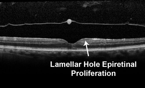 Lamellar Hole Epiretinal Proliferation - LHEP
