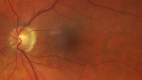 Phototoxicity following cataract surgery
70 year old female with nasal  spot in vision since cataract  surgery 3 years ago.  VA 20/20 OU.
