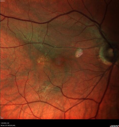 Phototoxicity following cataract surgery
70 year old female with nasal  spot in vision since cataract  surgery 3 years ago.  VA 20/20 OU.
