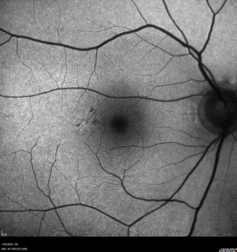 Phototoxicity following cataract surgery
70 year old female with nasal  spot in vision since cataract  surgery 3 years ago.  VA 20/20 OU.
