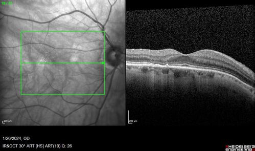Phototoxicity following cataract surgery
70 year old female with nasal  spot in vision since cataract  surgery 3 years ago.  VA 20/20 OU.
