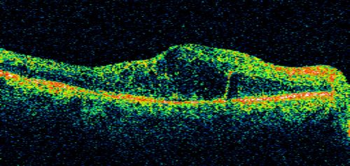 Diabetic and Pseudophakic Cystoid Macular Edema Pretreament Line OD
56-year-old woman has diabetic retinopathy in both eyes and macular edema.  She is recently pseudophakic.  OD 20/80, OS 20/200.  
Keywords: cme;bdr;pseudophakic;laser;kenalog
