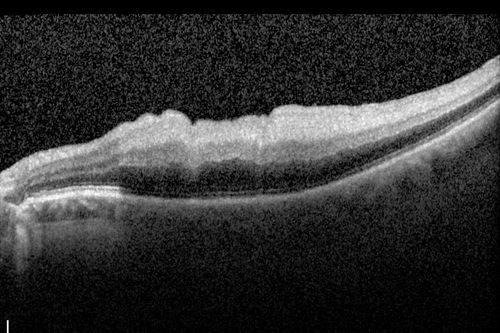 Central Retinal Artery Occlusion with Cilioretinal Sparing - Acute - SD-OCT Line Scan Inner retinal edema
 77-year-old man was doing fine until midnight of last night when he noticed sudden severe vision loss in the left eye. VISUAL ACUITY:  OD 20/20,  OS 2/200.
