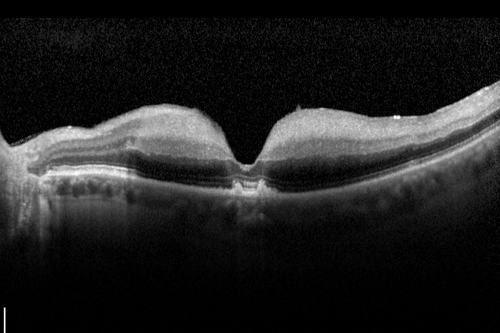 Central Retinal Artery Occlusion with Cilioretinal Sparing - Acute - SD-OCT Line Scan Inner retinal edema
 77-year-old man was doing fine until midnight of last night when he noticed sudden severe vision loss in the left eye. VISUAL ACUITY:  OD 20/20,  OS 2/200.
