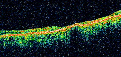 Pistol to head in attempted suicide 3 Months Ago - Retinal Atrophy - Shockwave Retinopathy VA Right Eye - Light Perception - Left Eye - 20/400
66-year-old woman had a gunshot wound to the head on August 12, 2010, with the entry wound just on the right side, just about below her temple, toward the lower part of the temple and the exit wound on the left side just above her cheek, a little behind the eye.  Since then she recovered and did not need any surgery.  When that all cleared she realized her vision was poor in both eyes.  She has seen a neuro-ophthalmologist who thought she had traumatic optic neuropathy.   OD light perception, OS 20/400. 
