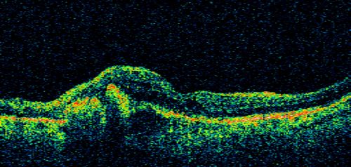 AMD - Wet - Fibrovascular Hemorrhagic PED - Occult CNVM
87-year-old woman for one month OS:  20/60 Fibrovascular PED and Hemorrhage
Palabras clave: ped;fibrovascular;occult;hemorrhage;wet AMD