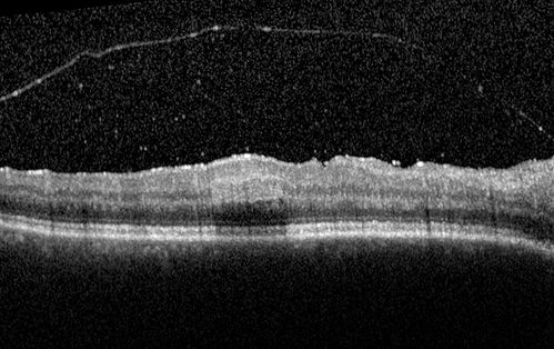 Birdshot Chorioretintis and PAMM
Patient presented with paracentral acute middle maculopathy as the presenting symptom of birdshot.  This case was published. RETINAL CASES & BRIEF REPORTS 10:151â€“153, 2016.
