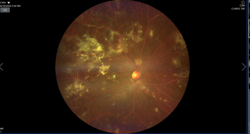 Lipemia Retinalis
31 year old man The patient at the time of imaging had triglycerides of >5680, cholesterol of 1136.

He also does have uncontrolled hypertension and insulin dependent type 2 diabetes, which may be the reason for vitreous extension of the lipids.
