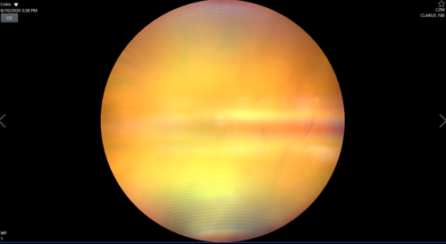 Lipemia Retinalis - Lipid Obscuring Vitreous
31 year old man The patient at the time of imaging had triglycerides of >5680, cholesterol of 1136.

He also does have uncontrolled hypertension and insulin dependent type 2 diabetes, which may be the reason for vitreous extension of the lipids.
