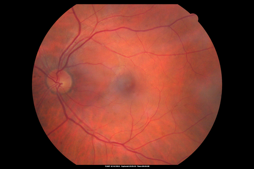 Serous Retinal Detachment - Hypertensive Retinopathy - 165/120 
48-year-old woman noticed when she was blinking there was a white flash in the left eye starting about a month ago.  She sees it temporally.  OD 20/16,  OS 20/20.  There is a serous retinal detachment superotemporal to the optic nerve falling short of the fovea.   Her blood pressure 165/120. 
