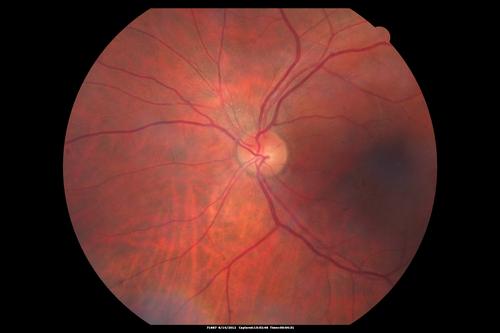 Serous Retinal Detachment - Hypertensive Retinopathy - 165/120 
48-year-old woman noticed when she was blinking there was a white flash in the left eye starting about a month ago.  She sees it temporally.  OD 20/16,  OS 20/20.  There is a serous retinal detachment superotemporal to the optic nerve falling short of the fovea.   Her blood pressure 165/120. 
