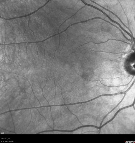 Serous Retinal Detachment - Hypertensive Retinopathy - 165/120 
48-year-old woman noticed when she was blinking there was a white flash in the left eye starting about a month ago.  She sees it temporally.  OD 20/16,  OS 20/20.  There is a serous retinal detachment superotemporal to the optic nerve falling short of the fovea.   Her blood pressure 165/120. 
